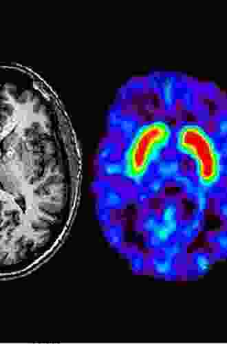 Imaging In Parkinson S Disease